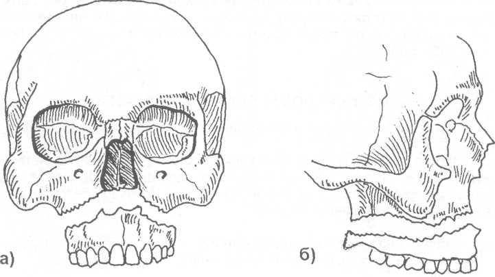 Перелом нижней и верхней челюсти: признаки, симптомы, лечение, сколько заживает