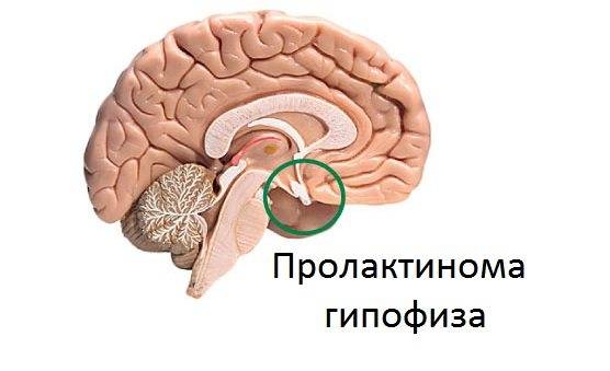 Микроаденома гипофиза головного мозга: что это такое, причины, симптомы, диагностика и лечение