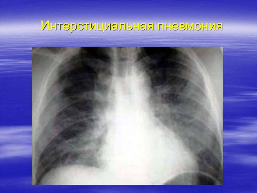 Пневмония. причины, симптомы, современная диагностика и эффективное лечение болезни.