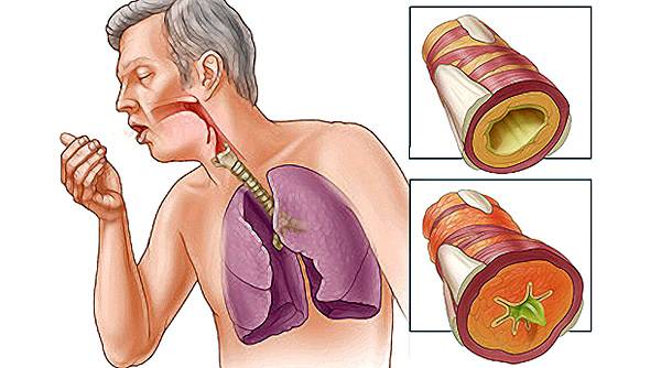 Слизь в горле и кашель: причины, диагностика, лечение