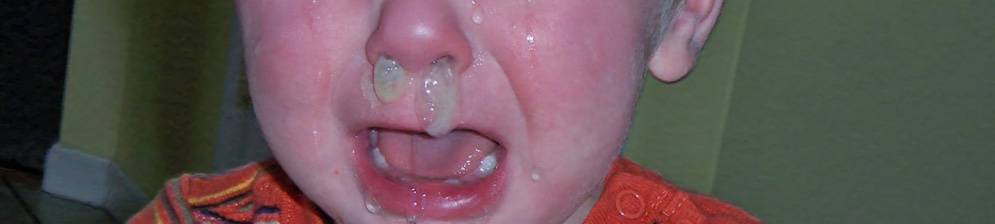 Сопли при прорезывании зубов у детей - как отличить от простуды?