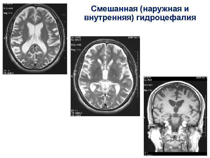 Гидроцефалия головного мозга: 11 причин возникновения болезни