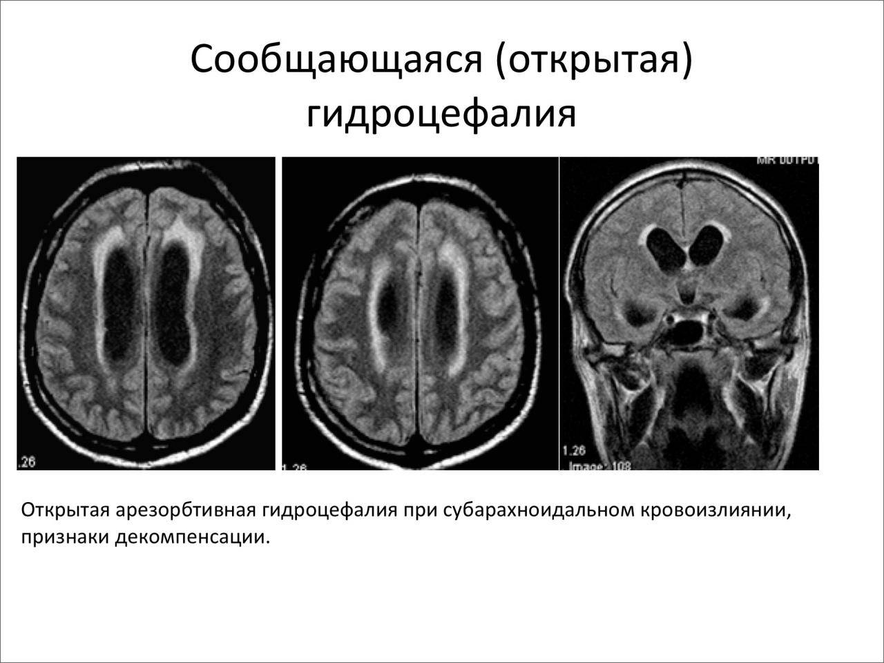 Смешанная заместительная гидроцефалия головного мозга - о болезнях