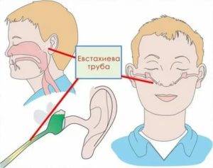 После орви заложило уши: что делать при боли и шуме в ушах, лечение