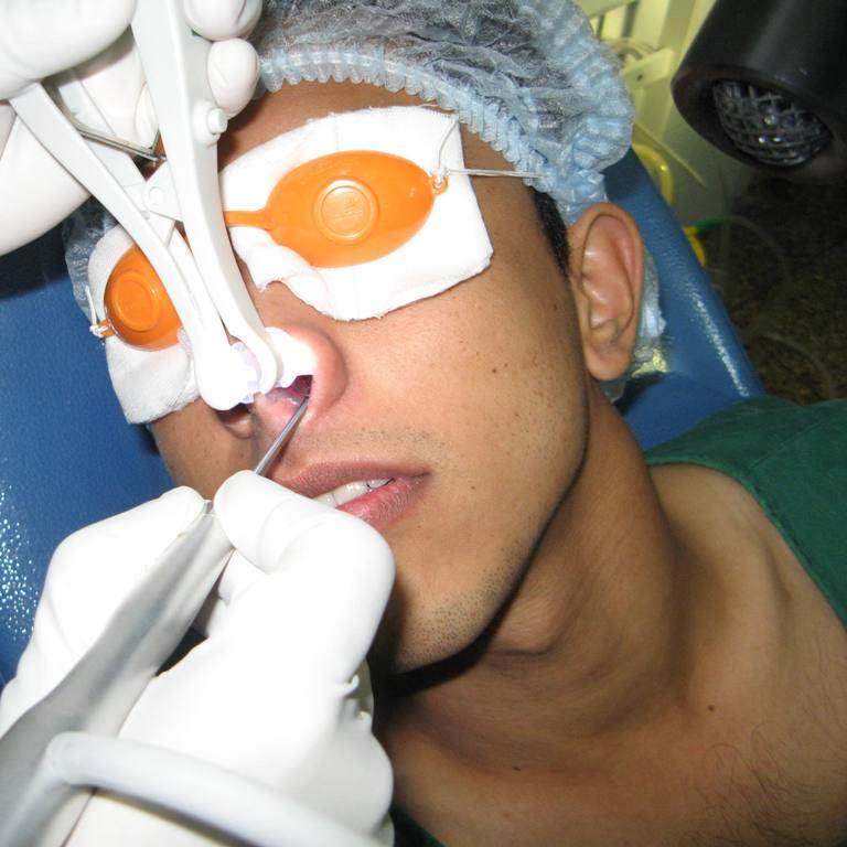 Исправление перегородки носа - операция: ринопластика искривления носовой
