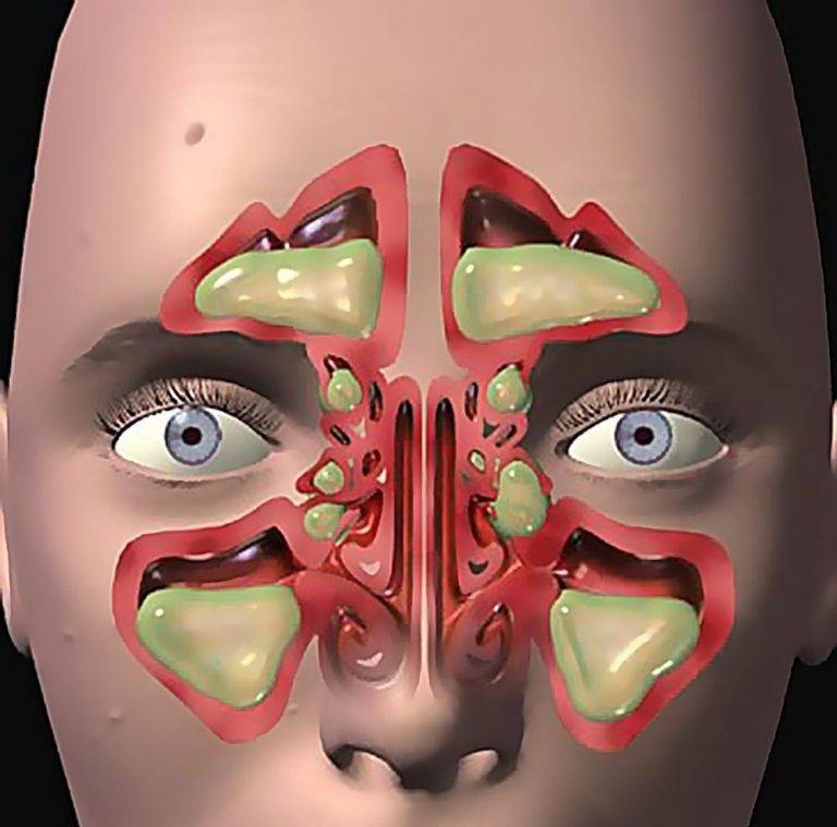 Воспаление слизистой оболочки носа: чем и как лечить, симптомы