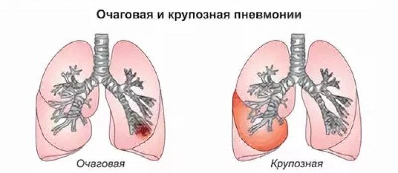 Лечение народными средствами воспаления лёгких (пневмонии)