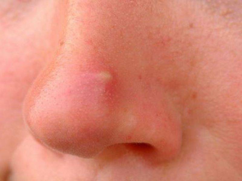 В носу постоянно образуются корки как лечить