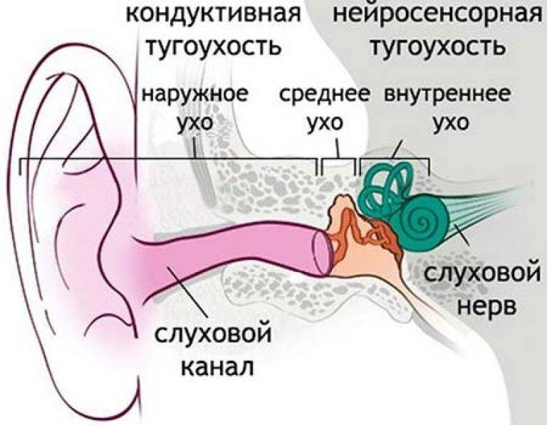 Кондуктивная и нейросенсорная потеря слуха. код по мкб-10 h90
