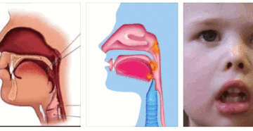 Аденоиды в носу у детей: симптомы и лечение аденоидов у ребенка