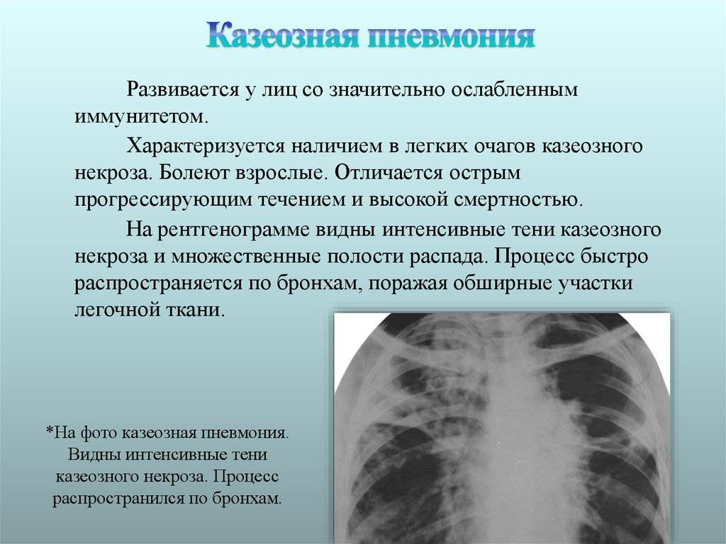 Двусторонняя пневмония: история болезни, лечение двустороннего воспаления легких у детей и взрослых