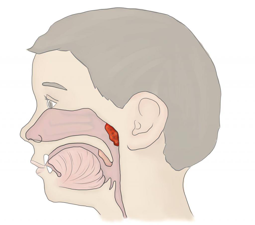 Аденоиды - симптомы: аденоидный тип лица у ребенка, признаки воспаления у детей, причины увеличенных в носоглотке