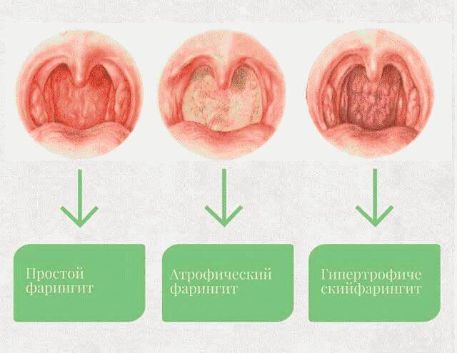 Боль в горле при глотании: справа, слева, с одной стороны, чем лечить?