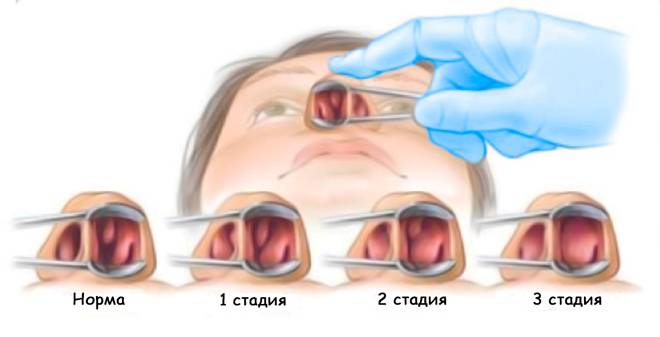 Полипы в носу: что это такое, симптомы, удаление и лечение полипоза
