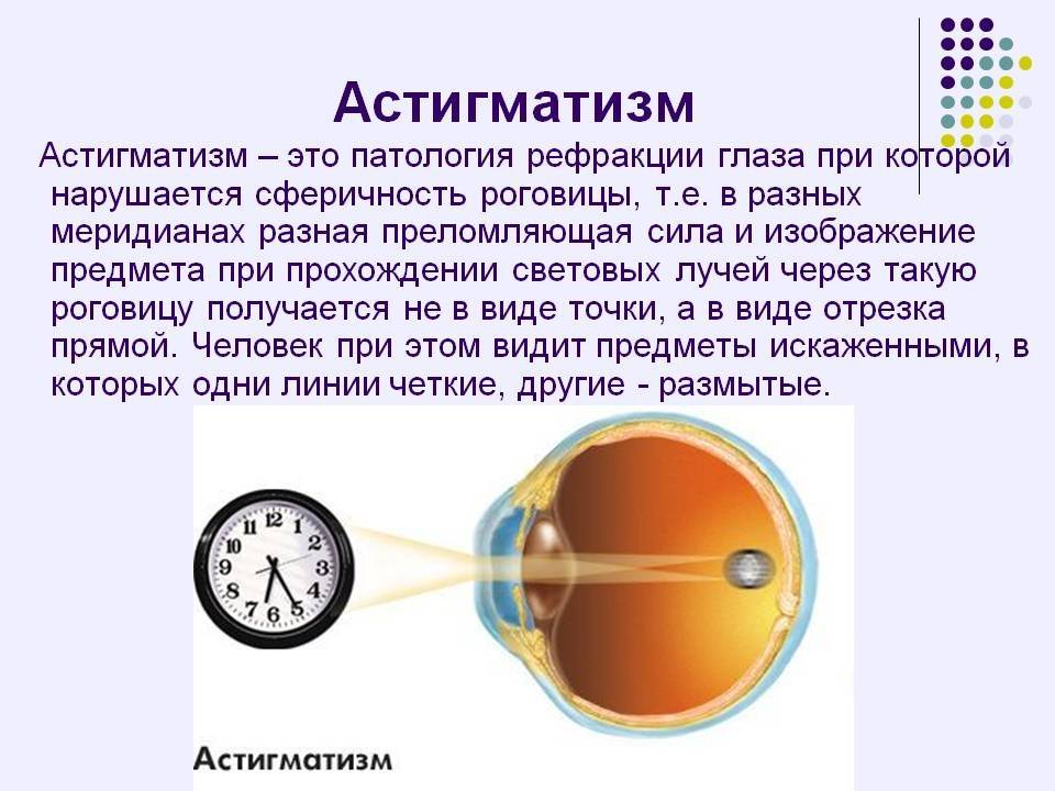 Астигматизм - что это у детей: сложный, гиперметропический, прямой глаз