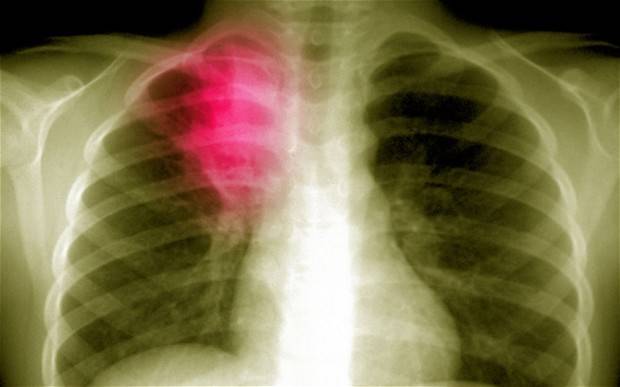 Коварное заболевание пневмония: как диагностировать и чем лечить болезнь у взрослых