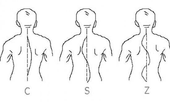 S-образный сколиоз 1,2,3,4 степени: лечение и упражнения