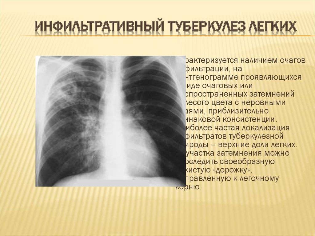 Инфильтративный туберкулез верхней доли правого легкого, ответы врачей, консультация