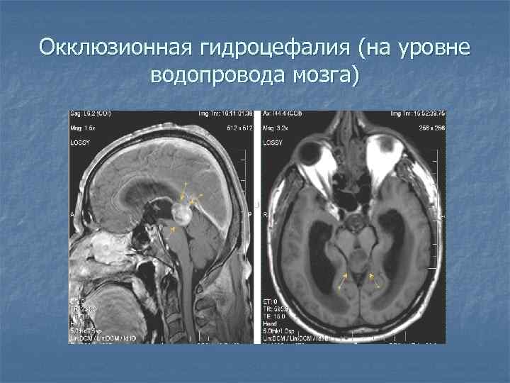 Заместительная наружная гидроцефалия головного мозга: что это такое и как лечить