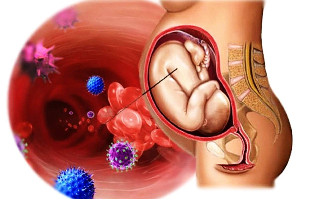 Внутриутробная инфекция при беременности (вуи): причины, признаки, последствия