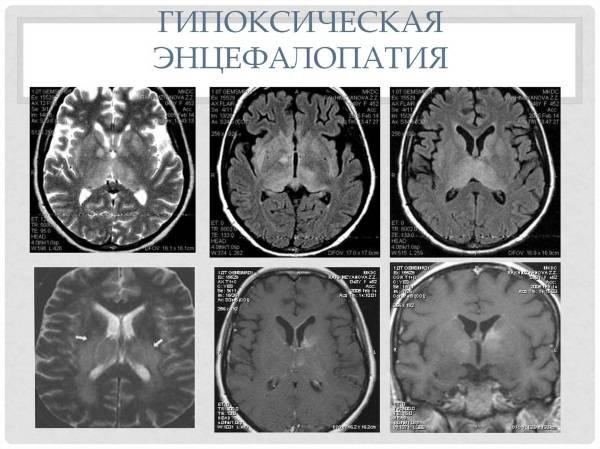 Последствия энцефалопатии головного мозга у детей