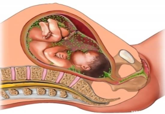 Ангина при беременности: лечение и последствия