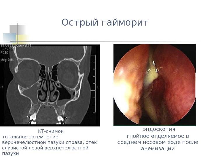 Одонтогенный гайморит (синусит) из-за больного зуба: симптомы и лечение