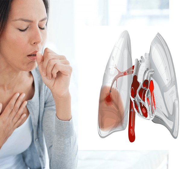 Сердечный кашель симптомы лечение