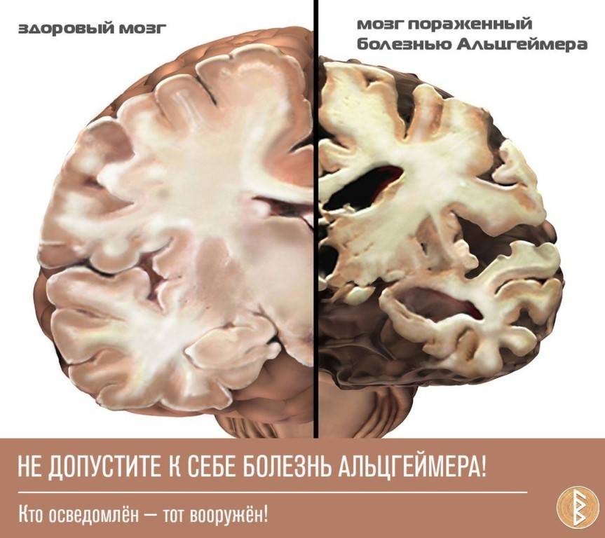 Методы и способы лечения болезни альцгеймера