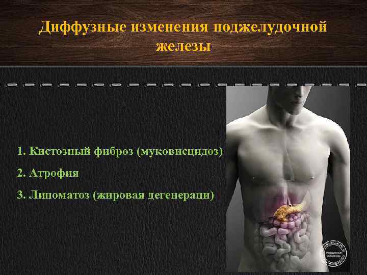 Липоматоз поджелудочной железы: симптомы, лечение и признаки. народные средства | nowfoods-ru.ru