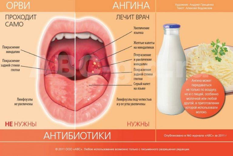 Борьба с инфекцией в гортани: натуральные и медикаментозные препараты