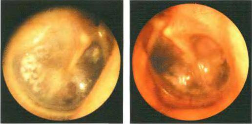 Средний отит уха — симптомы и лечение