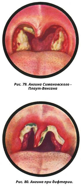 Ангина симановского-венсана (язвенно-пленочная): причины, симптомы