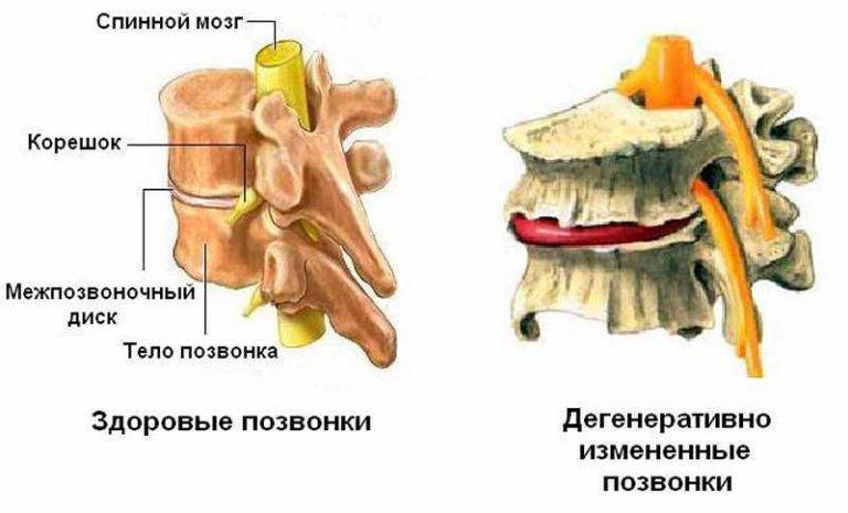 Дегенеративно-дистрофические изменения шейного, грудного и пояснично-крестцового отдела позвоночника