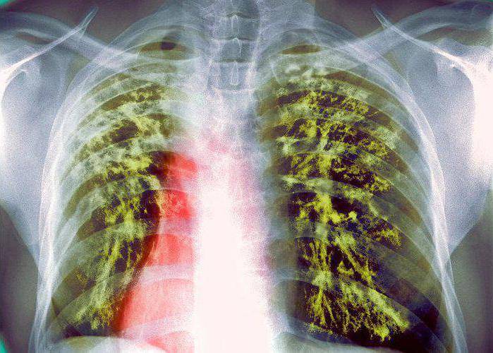 Вторичный туберкулез легких (рецидив): симптомы, признаки и лечение