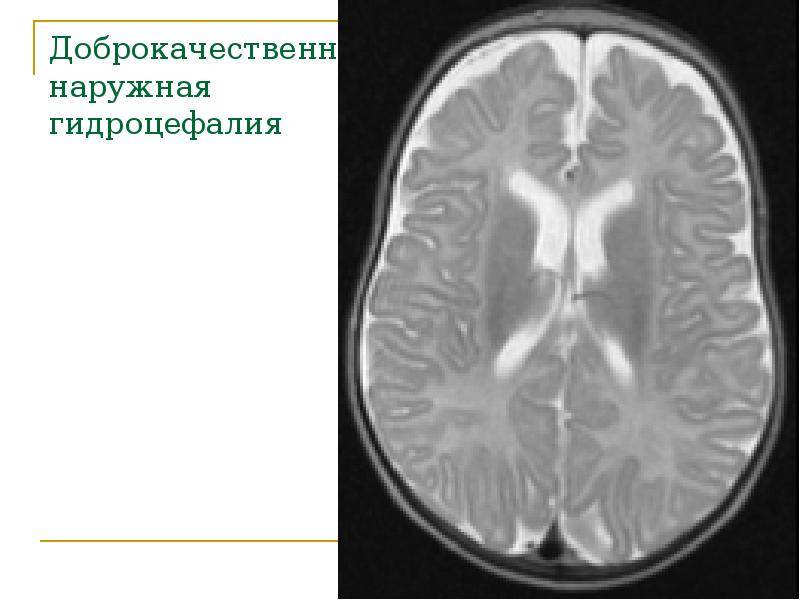 Заместительная гидроцефалия головного мозга у взрослых