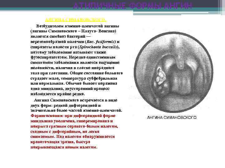 Ангина симановского-венсана: симптомы, лечение и причины некротической формы