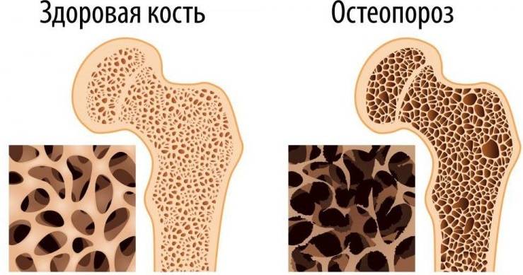 Лечение остеопороза народными средствами — причины, симптомы и профилактика