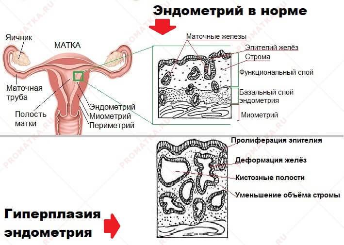 Гиперплазия эндометрия в менопаузе: лечение, симптомы, виды