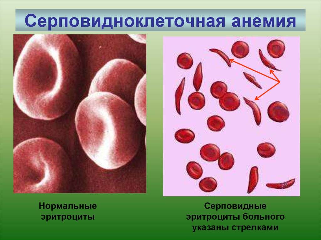Серповидноклеточная анемия: симптомы, лечение, диагностика и причины
