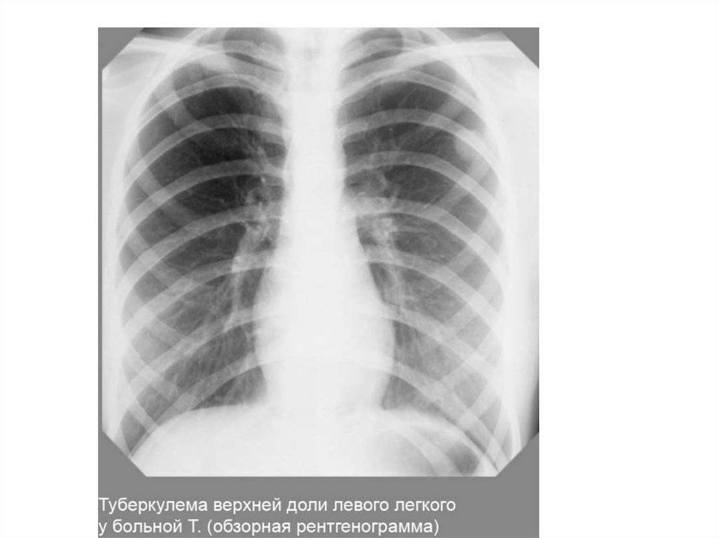 Очаговый туберкулез легких: заразен или нет, свежий, для окружающих
