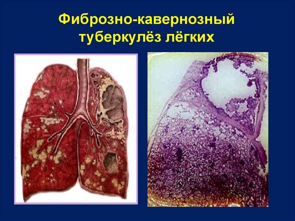 Посттуберкулезные изменения, осложнения и последствия перенесенного туберкулеза — стоптубик