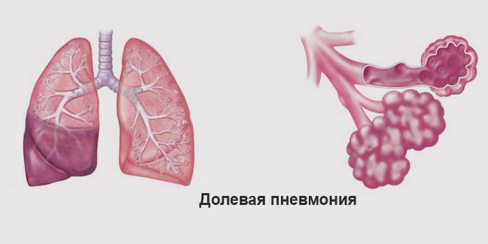 Вялотекущая пневмония симптомы у взрослых