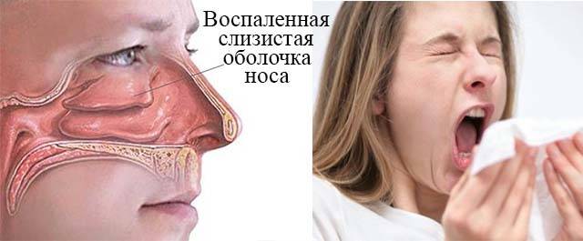 Отек слизистой носа у взрослого (нос заложен, а соплей нет)