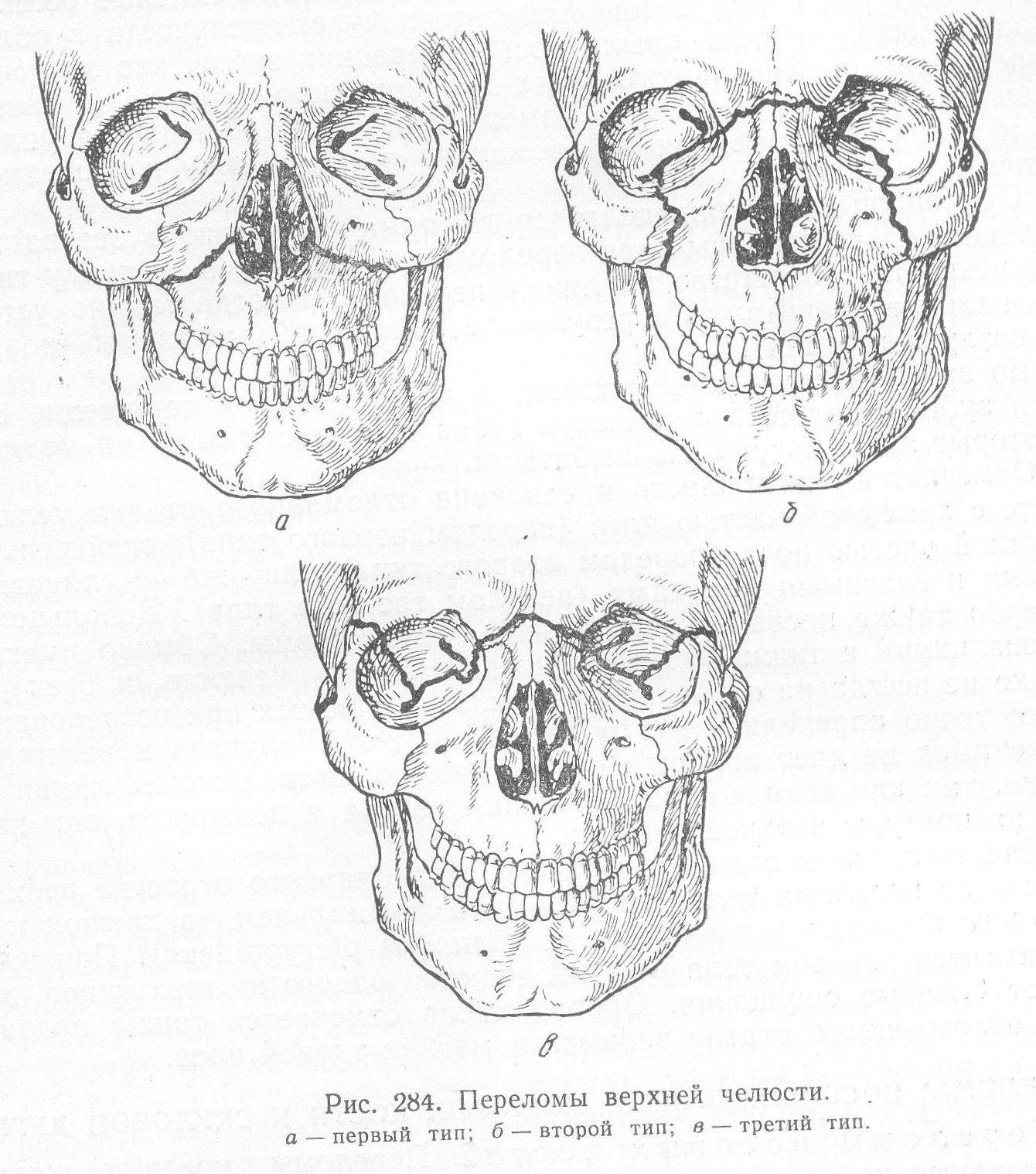 Перелом верхней челюсти: классификация, симптомы, лечение