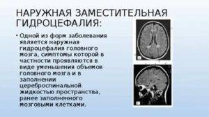 Гидроцефалия головного мозга у взрослых- симптомы, лечение | азбука здоровья