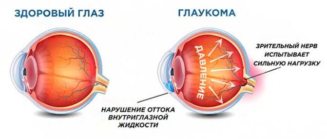 Лечение катаракты народными средствами — отзывы вылечившихся