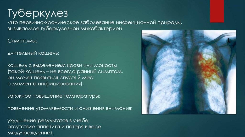 Пять отличий пневмонии и туберкулеза — стоптубик