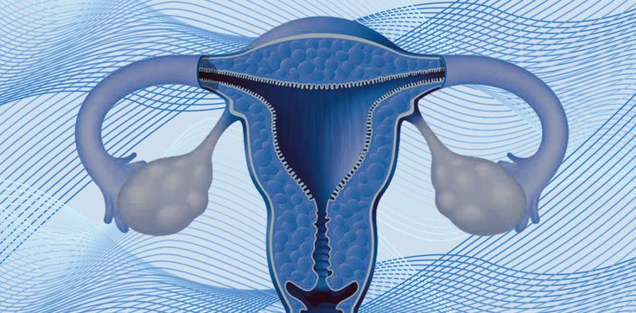 Гиперплазия эндометрия матки - что это, чем и как лечить, симптомы, виды