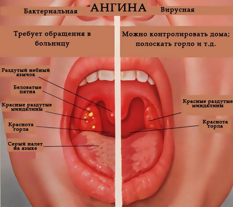 Бисептол при боли в горле